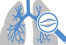 Bronchiektasen – eine vielfach unterschätzte Atemwegserkrankung