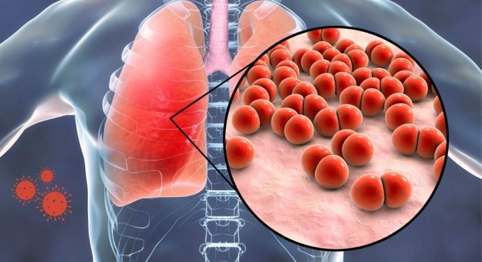 Illustration Lungenentzündung durch Pneumokokken verursacht, Credit Canva