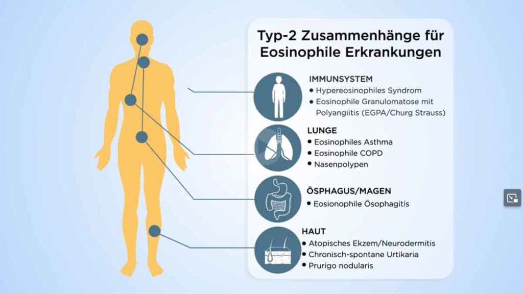 Eosinophile