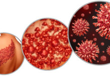 Gürtelrose – Ursachen, Verlauf, Folgen und Schutz durch Impfung