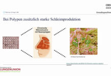 Chronische Nebenhöhlenentzündung mit Nasenpolypen