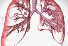 Bronchiektasen – eine vielfach unterschätzte Atemwegserkrankung Bronchiektasen-Atemwegserkrankung