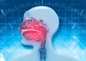 CRSwNP – Chronische Nebenhöhlenentzündung mit Polypen