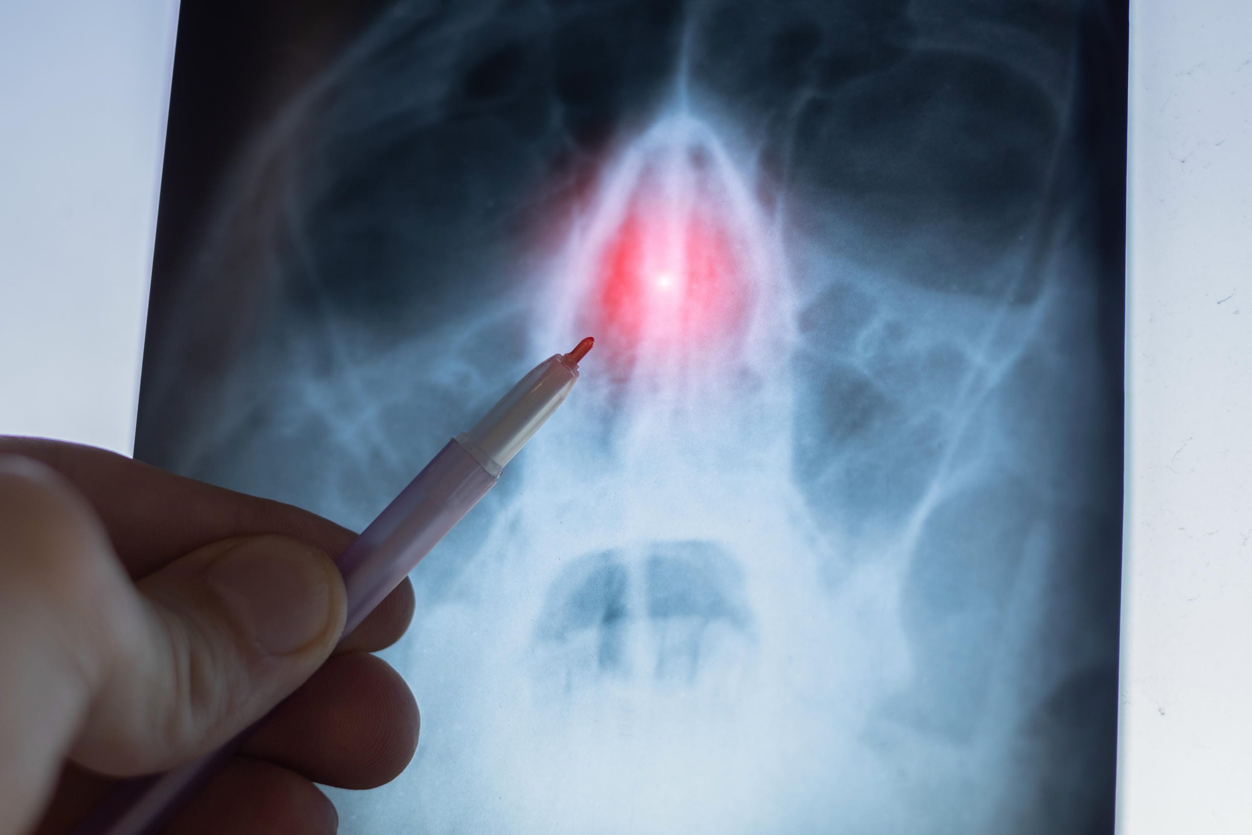 CRSmNP – Eine chronische Entzündung mit Nasenpolypen benötigt fachärztliche Abklärung